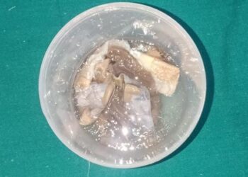 અમદાવાદની સિવિલ હોસ્પિટલને મળ્યું ૧૦મું સ્કિન ડોનેશન. ઘરે જઇ મેળવવામાં આવેલ ચોથુ સ્કીન દાન