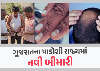‘ગંજા વાયરસ’ બાદ હવે અચાનક મૂળમાંથી ખરવા લાગ્યા લોકોના નખ, રહસ્યમયી બીમારીથી હડકંપ | people nails ha…