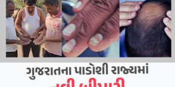 ‘ગંજા વાયરસ’ બાદ હવે અચાનક મૂળમાંથી ખરવા લાગ્યા લોકોના નખ, રહસ્યમયી બીમારીથી હડકંપ