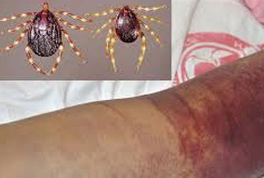 અમરેલી જિલ્લામાં 12 વર્ષે કોંગો ફીવરનો શંકાસ્પદ કેસ | Suspected case of Congo fever in Amreli distri…