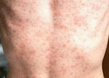 જિલ્લાના ગ્રામ્યવિસ્તારમાં ઓરીના બાળદર્દીઓમાં ચિંતાજનક વધારો | Alarming increase in measles cases in…