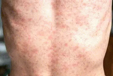 જિલ્લાના ગ્રામ્યવિસ્તારમાં ઓરીના બાળદર્દીઓમાં ચિંતાજનક વધારો | Alarming increase in measles cases in…