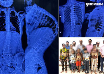 અમદાવાદ સિવિલમાં 7 બાળકોની સાપની જેમ વાંકી વળી ગયેલી કરોડરજ્જુના ઓપરેશન સફળ, નિઃશુલ્ક સર્જરી કરાઈ | …